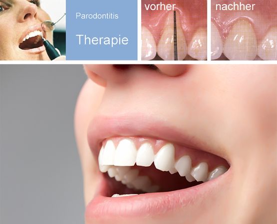 Parodontitis-Behandlung im Überblick
